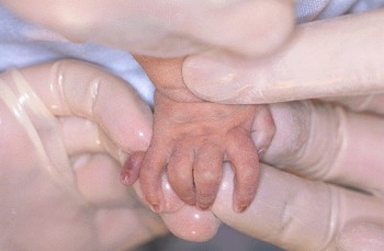 Patau Syndrome Patau (6).jpg